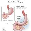 Living with a gastric sleeve