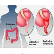 Principais Sintomas Do Apendicite
